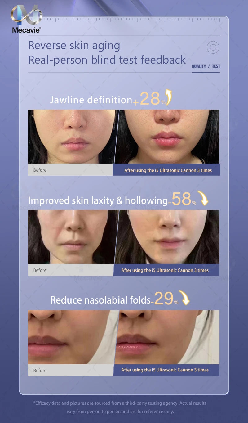 Mini Ultrasonic Face Lifting Device Deeply Stimulates SMAS Layer for V-Line Shaping Wrinkle Removal & Anti-Aging Painless Facial